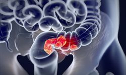 Kolorektal Kanserde Erken Teşhis Hayat Kurtarıyor